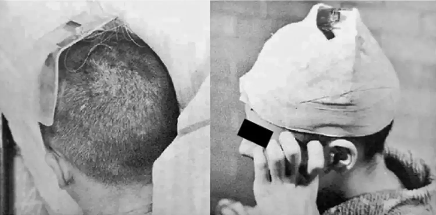 Two photos showing a headpiece mounted to a man with a shaved head. The first photo shows the headpiece and the back of the head, while the second one shows the headpiece and head wrapped in tape.